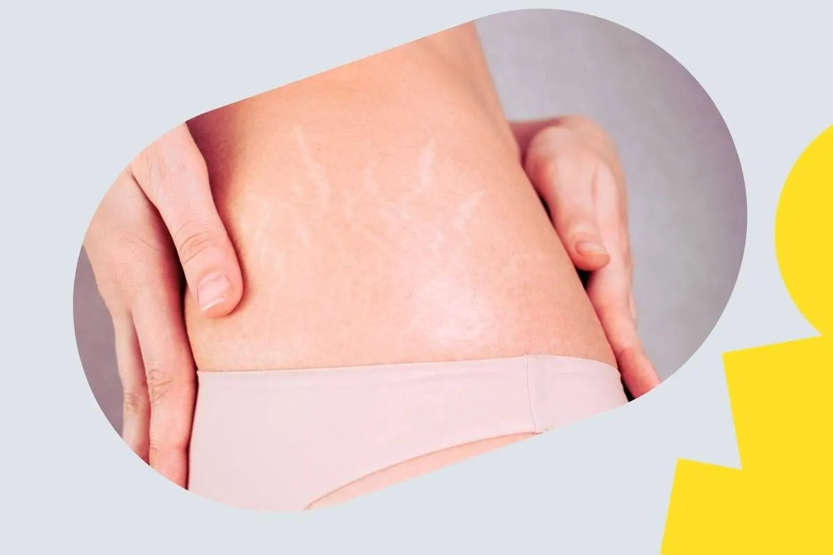 Pielęgnacja sk&oacute;ry przeciw rozstępom