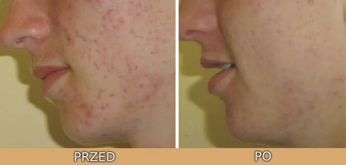 kwas salicylowy i hialuronowy razem efekty