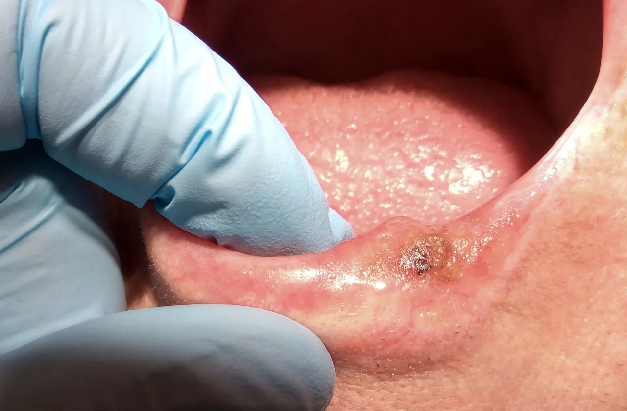 zaawansowany rak dziąseł zdjęcia owrzodzenia guzy