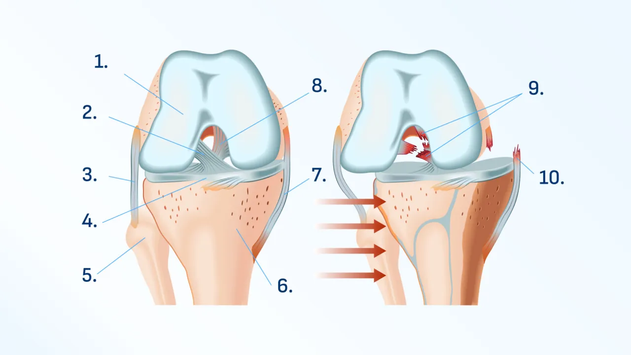 Anatomia kolana i przyczyny b&oacute;lu