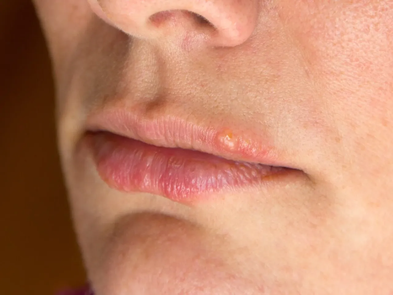 Zbliżenie na usta z widoczną, zaczerwienioną opryszczką na górnej wardze.