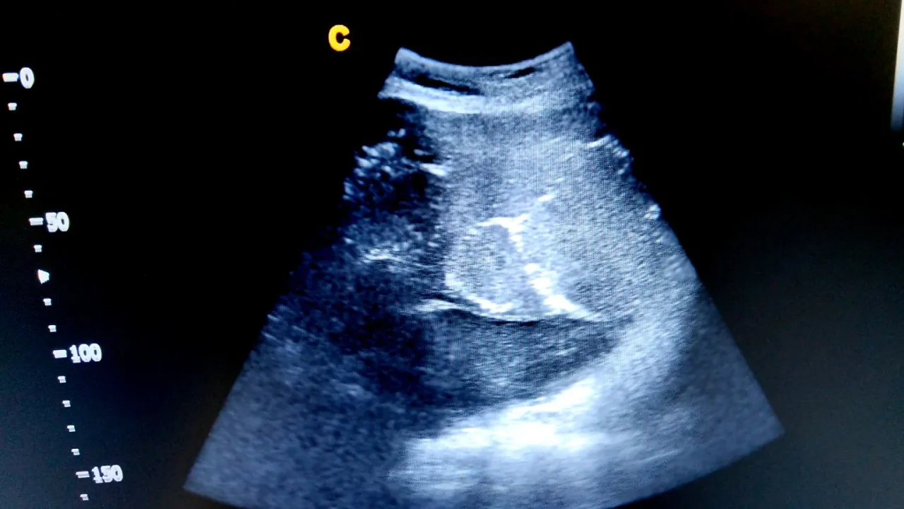 ciąża wczesna, rozciąganie macicy, implantacja zarodka