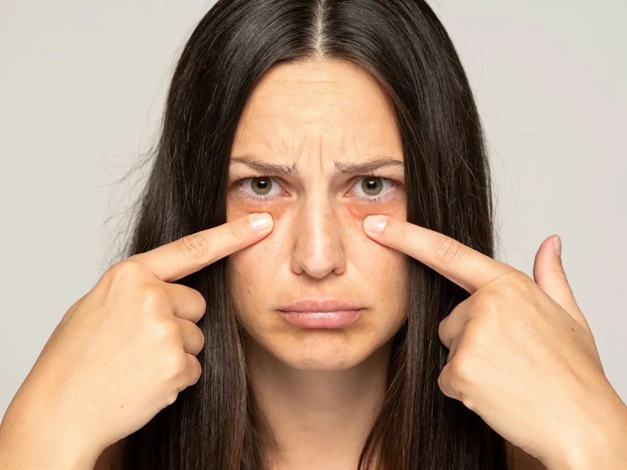 Obrzęki pod oczami objaw chorób nerek