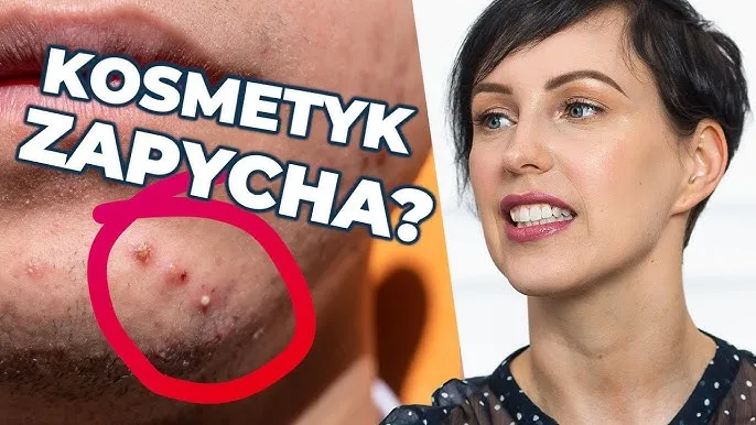 Zdjęcie Jak wygląda zapchana cera? Objawy i skuteczne sposoby leczenia
