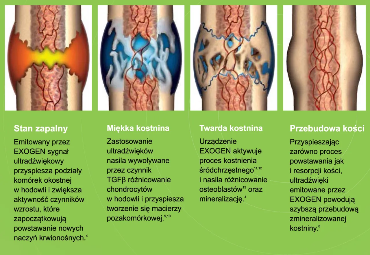 proces leczenia złamania infografika