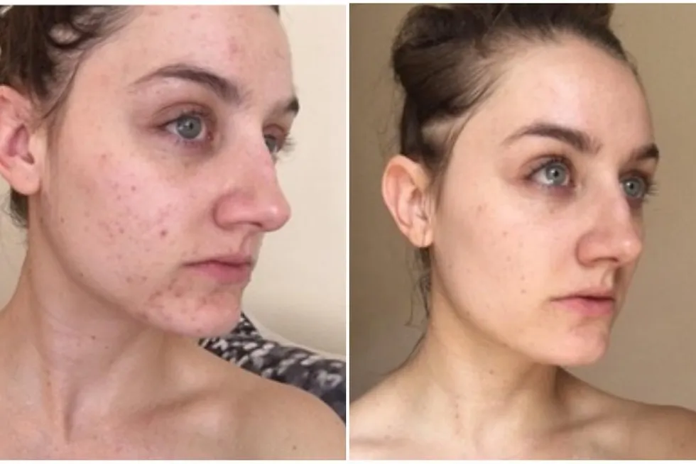 skutki niezmywania płynu micelarnego na sk&oacute;rze