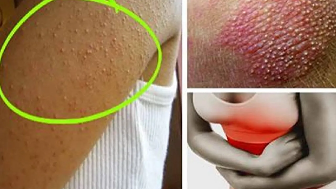 objawy nietolerancji glutenu zmęczenie ból brzucha wysypka