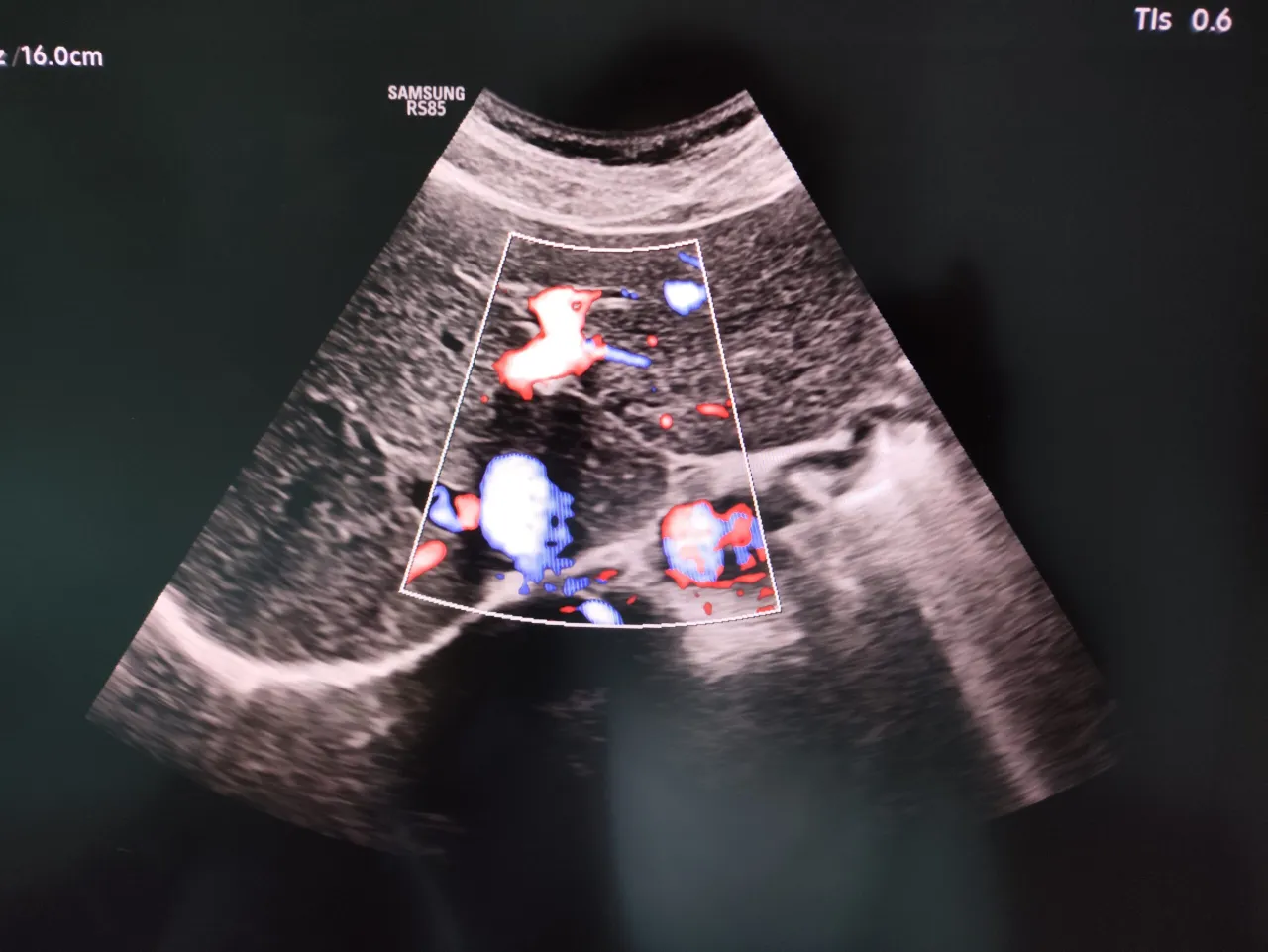 USG jamy brzusznej obraz