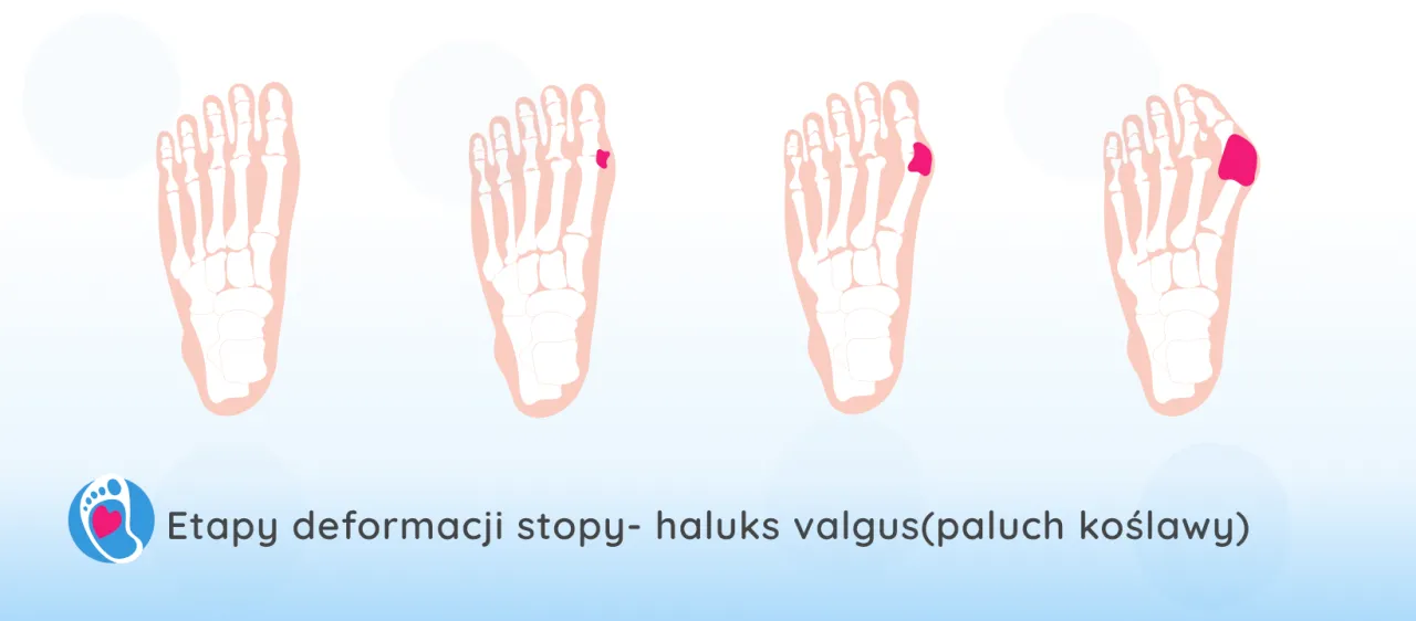 haluks etapy rozwoju deformacji stopy