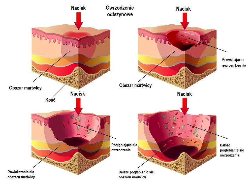 stopnie odleżyn schemat