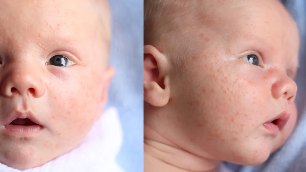 r&oacute;żnice pot&oacute;wki trądzik alergia niemowlę
