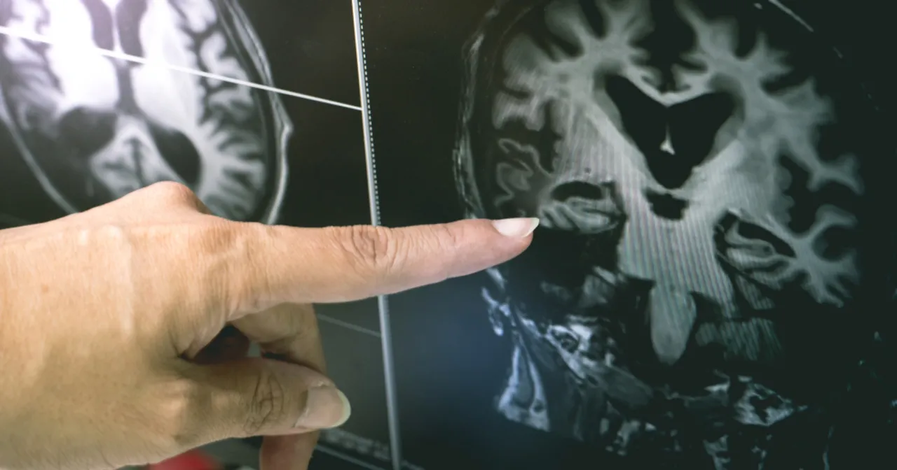 witamina D3 a choroby neurologiczne grafika