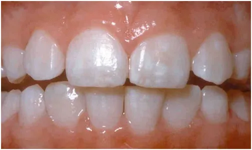 zęby z białymi plamami próchnicowymi i zdrowe zęby