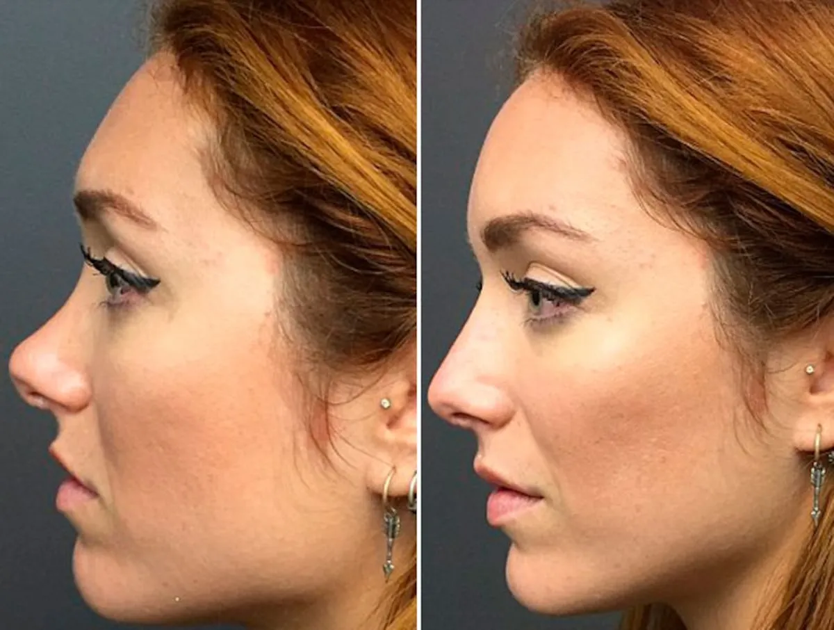 Zdjęcie Rinomodelación con ácido hialurónico: mejora tu nariz sin cirugía