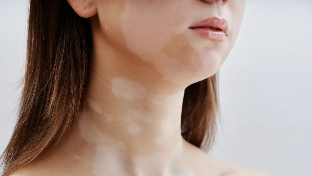 Kobieta z białymi plamami na skórze, widoczne usta i szyja.