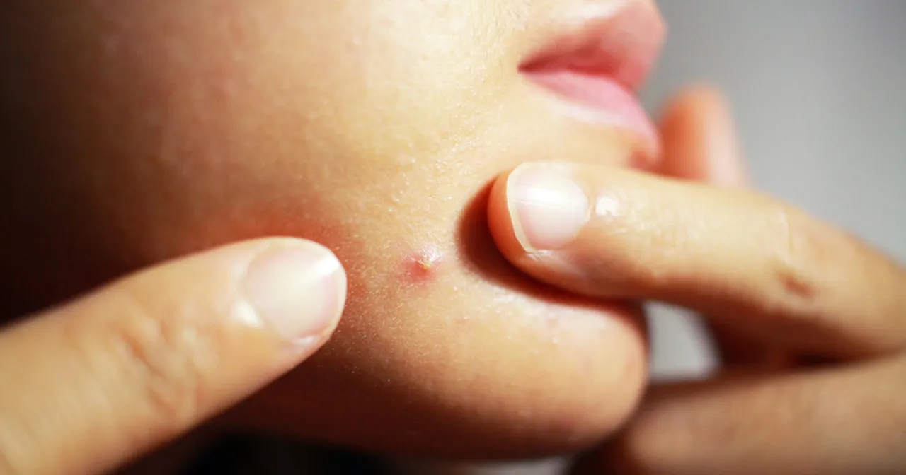 bezpieczne wyciskanie pryszcza krok po kroku