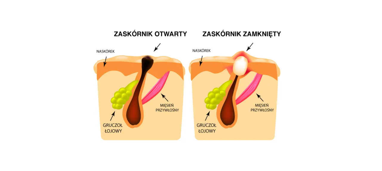objawy zapchanej cery zaskórniki otwarte zamknięte