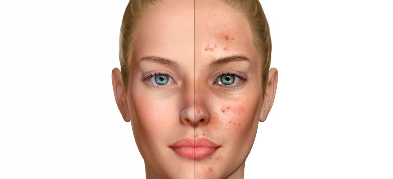 Porównanie skóry: po lewej gładka, po prawej z czerwonymi plamami po pryszczach. Jak wybielić czerwone plamy po pryszczach?