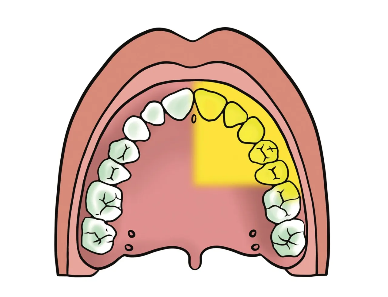 diagram zęba b&oacute;l miazgi, ilustracja ciśnienie w głowie