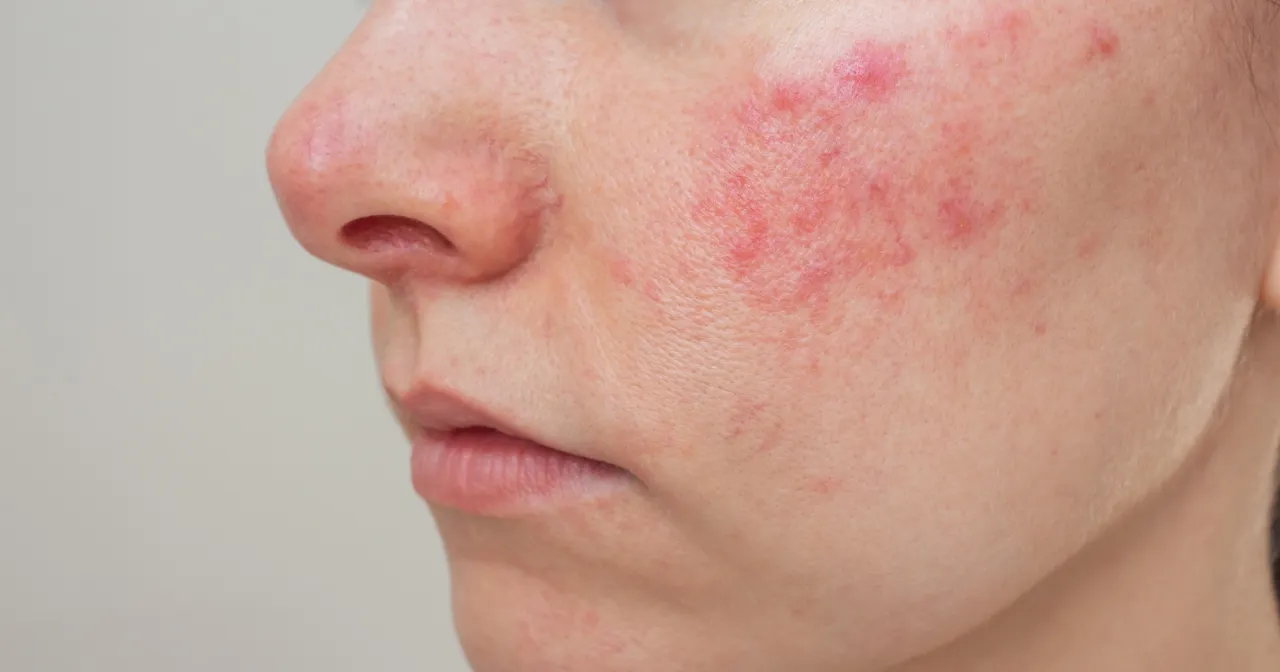 Błędy w pielęgnacji cery trądzikowej