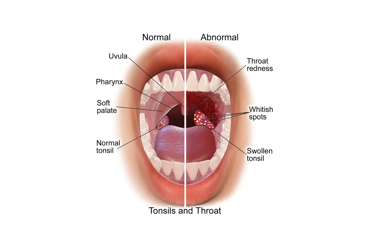 przerośnięty trzeci migdał u dziecka anatomia