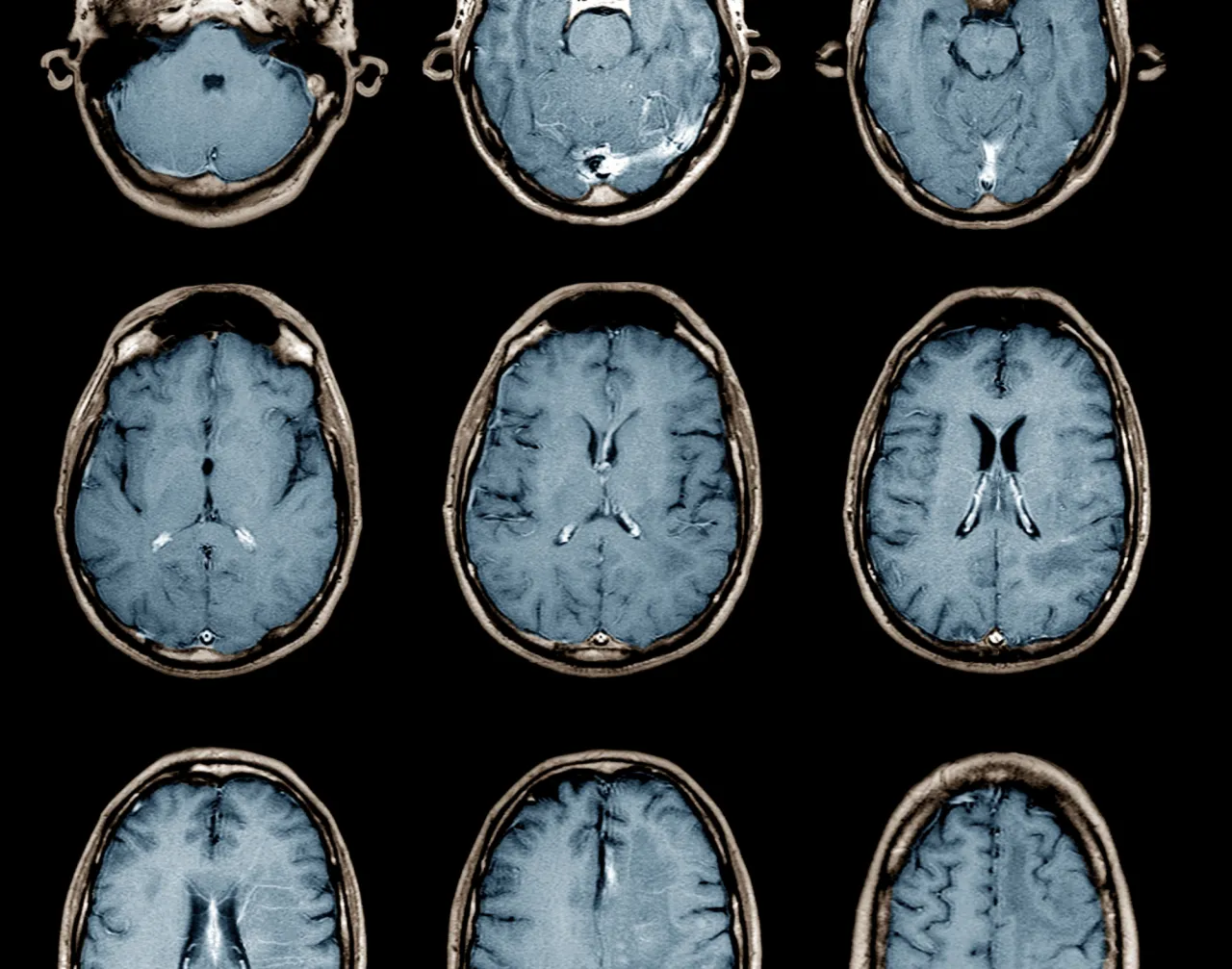 EEG czepki implanty mózgowe porównanie