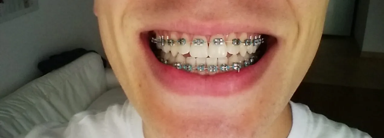 ortodonta zakłada aparat ortodontyczny krok po kroku