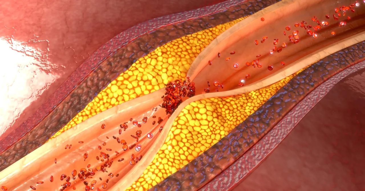Przekrój naczynia krwionośnego z blaszką miażdżycową. Badanie homocysteiny pomaga ocenić ryzyko chorób serca.