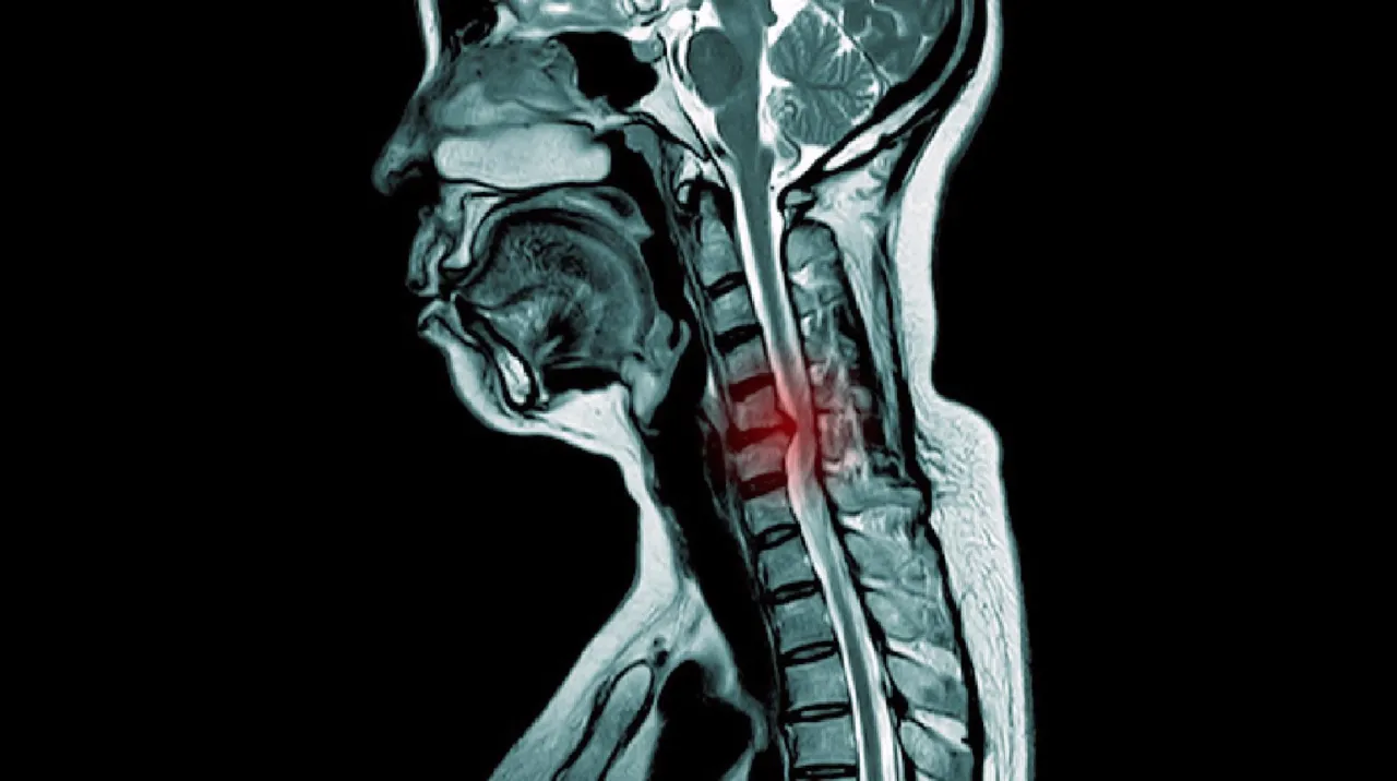 MRT Bandscheibenvorfall HWS Diagnose
