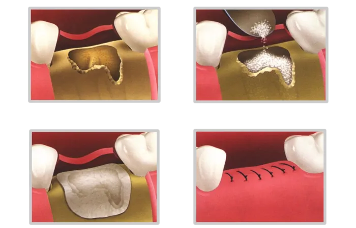 augmentacja kości przed implantem