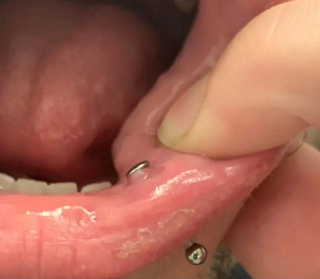 Blizna po kolczyku w wardze przed i po zagojeniu