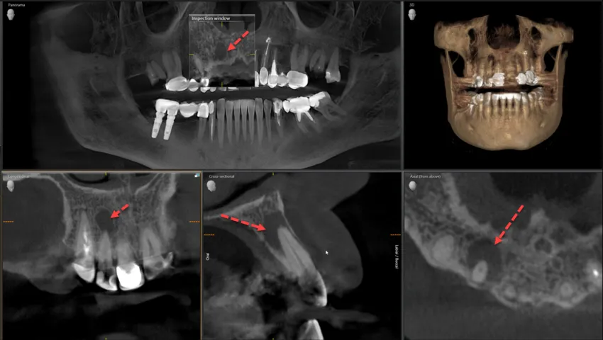 tomografia cbct zęba pęknięcie