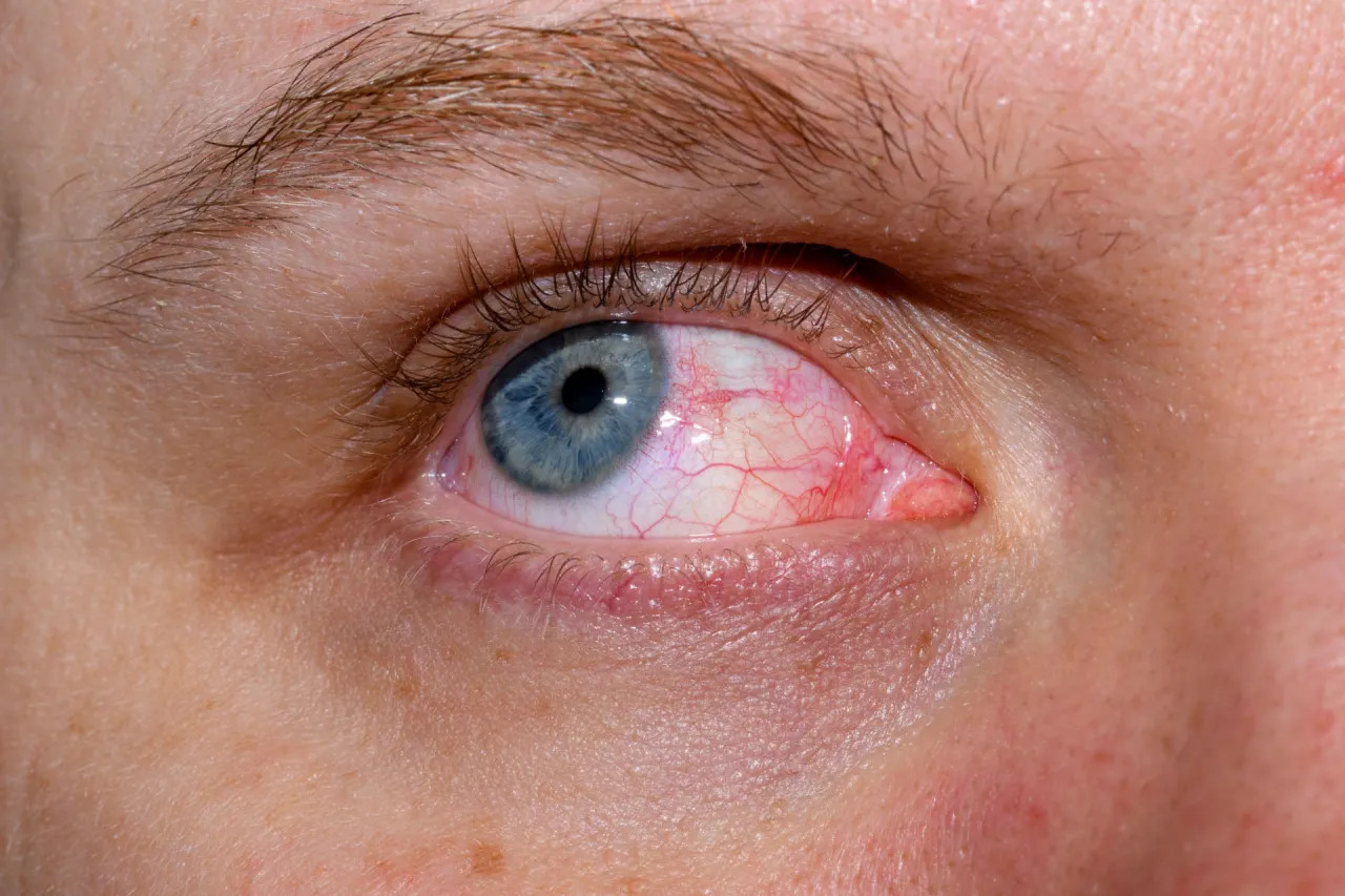 objawy alarmowe w oku