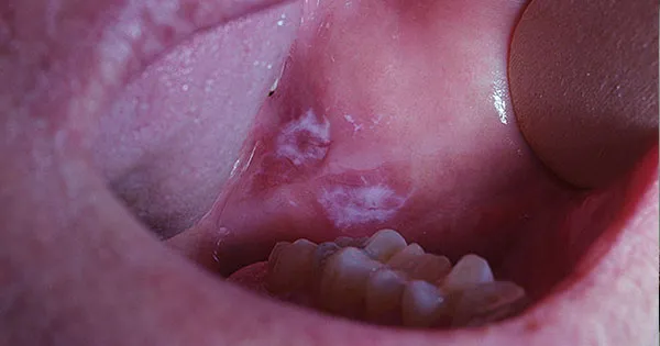 Niegojące się owrzodzenie w jamie ustnej zdjęcia rak