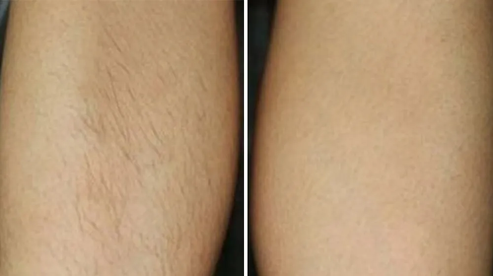 różne metody depilacji nóg porównanie