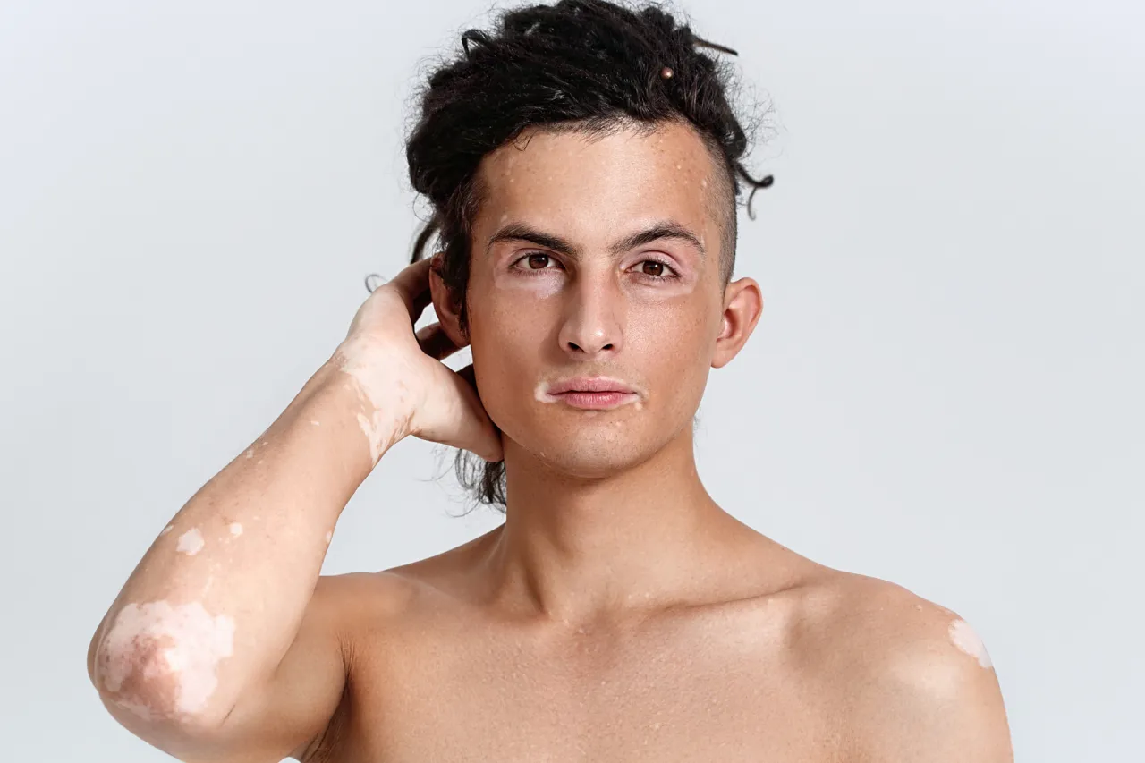 Młody mężczyzna z dredami i białymi plamami na skórze, dotykający ręką swojej głowy.
