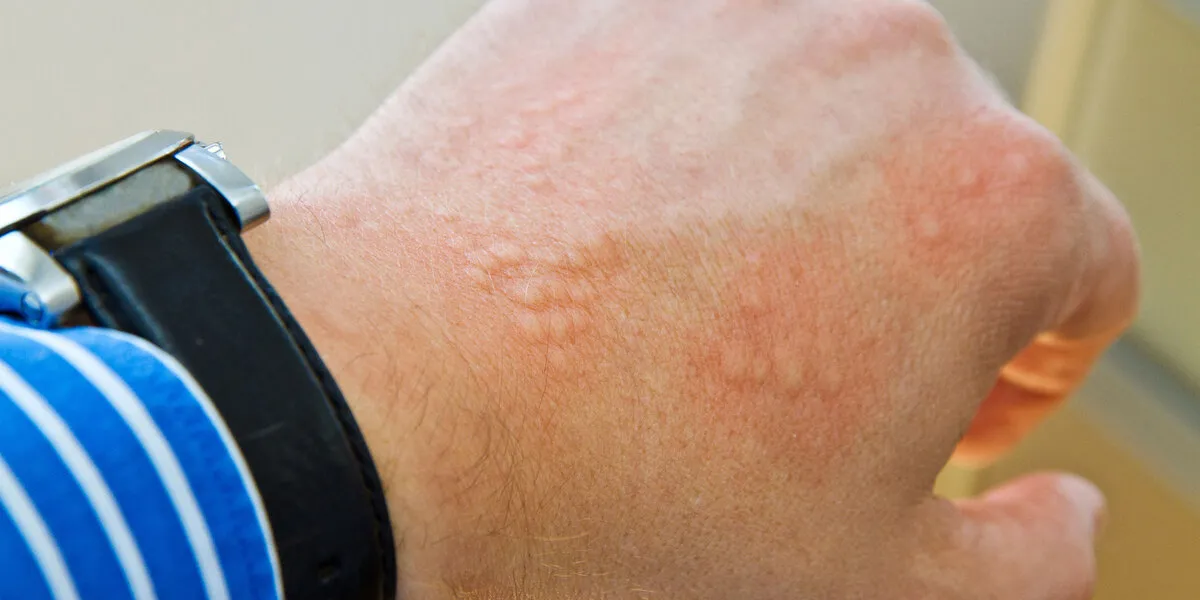 Zdjęcie Medikamente gegen Nesselsucht: Effektive Lösungen für juckende Quaddeln