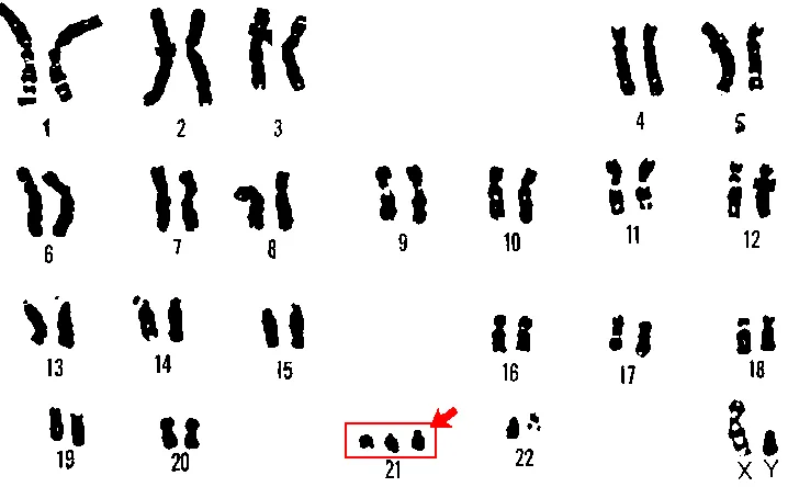 Zdjęcie Zespół Downa - ile ma chromosomów i co to oznacza dla zdrowia?