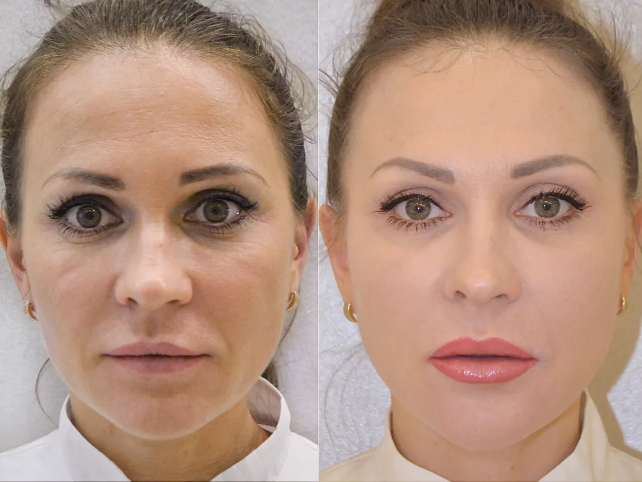 Kwas hialuronowy efekty przed i po