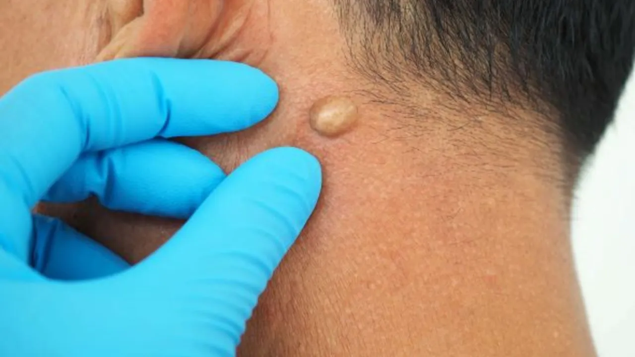 różne zmiany skórne tłuszczak kaszak znamię