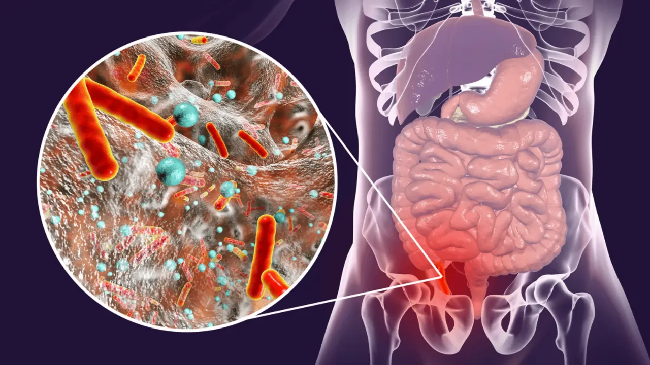 Mapa bólu brzucha zapalenie wyrostka
