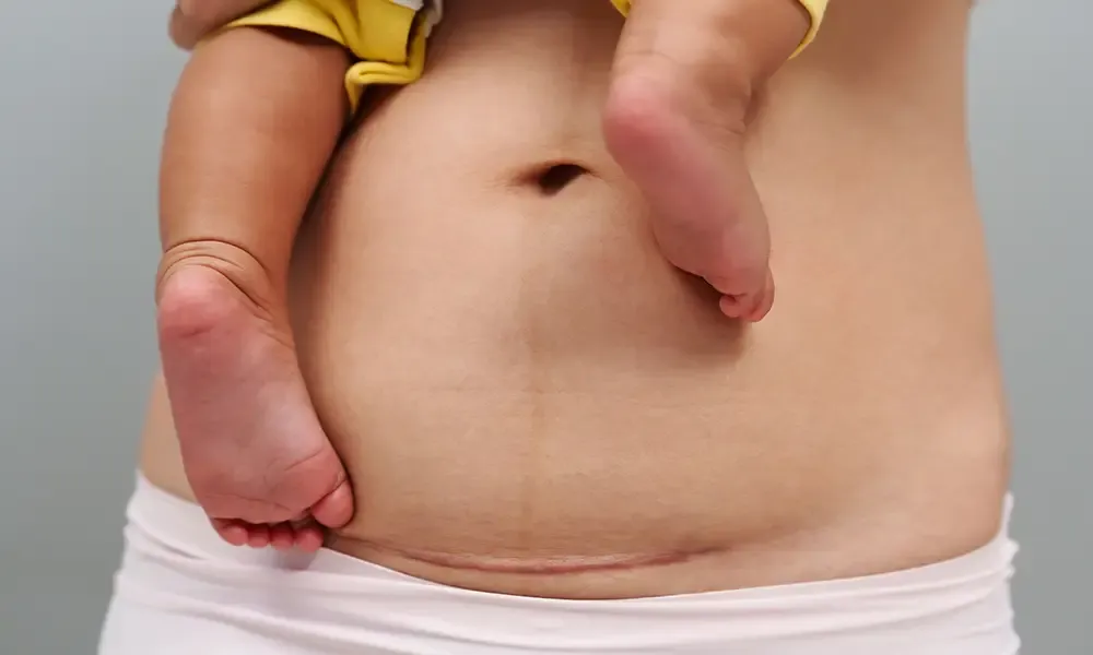 rana po cesarskim cięciu gojenie