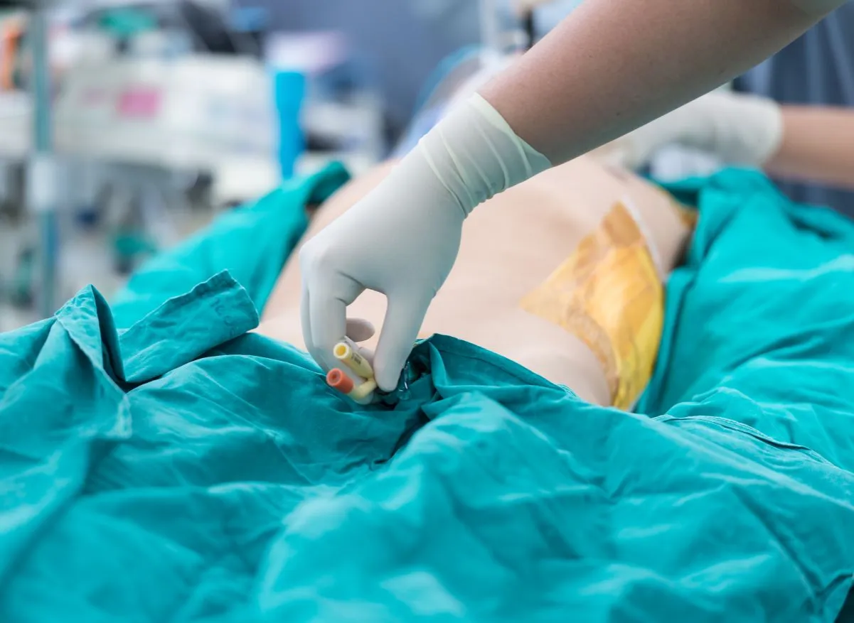 Cewnik Foleya budowa i zastosowanie