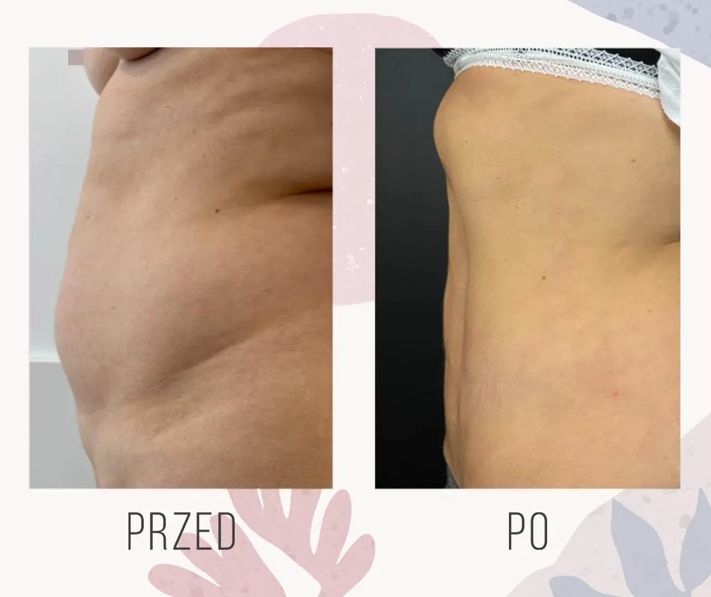 liposukcja co to jest i dla kogo