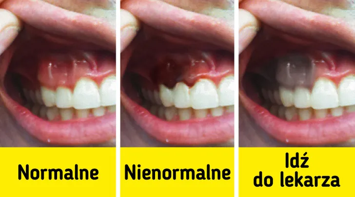 zdrowe dziąsła vs chore dziąsła, zapalenie dziąseł