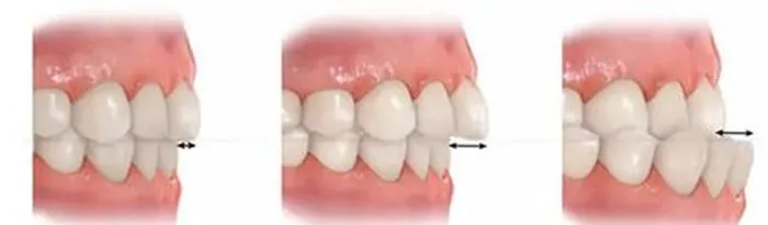 prawidłowy i nieprawidłowy zgryz