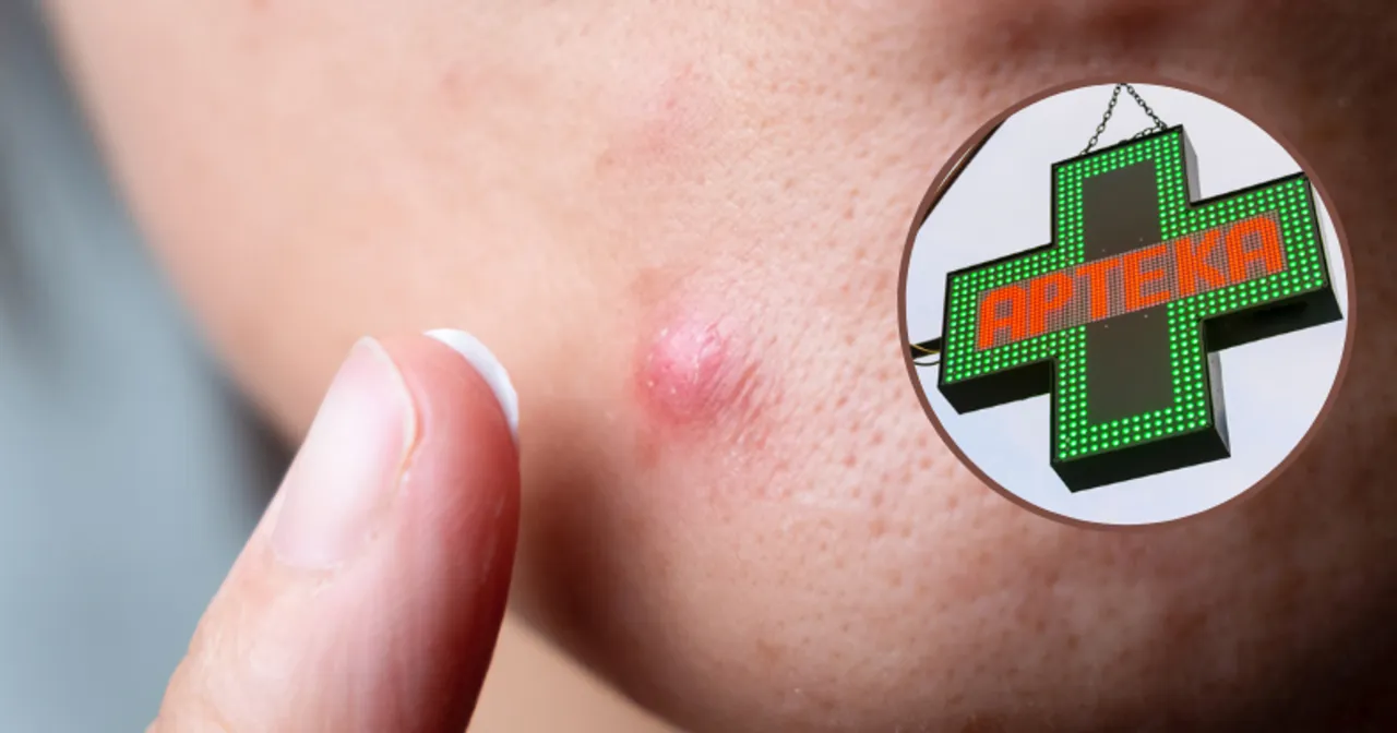 preparaty na pryszcze bez recepty, maść cynkowa ichtiolowa, plasterki na wypryski