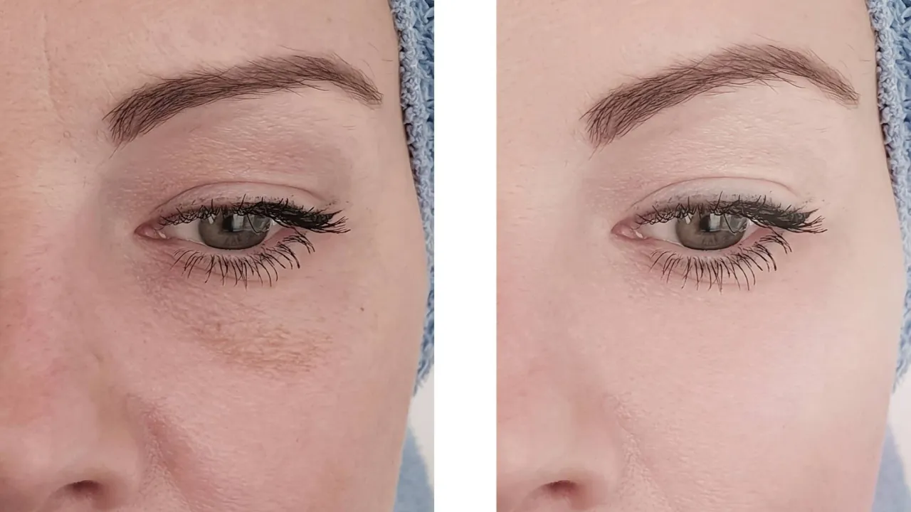 botoks kurze łapki przed po