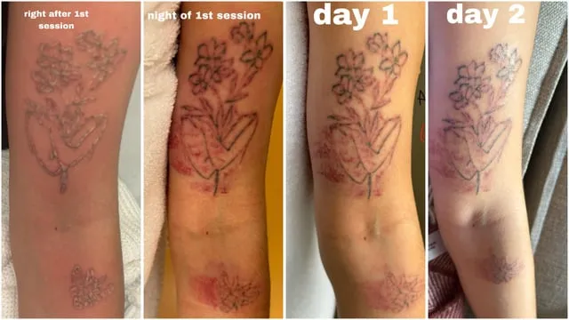 etapy gojenia tatuażu zdjęcia