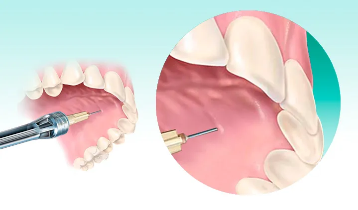 znieczulenie stomatologiczne mechanizm działania